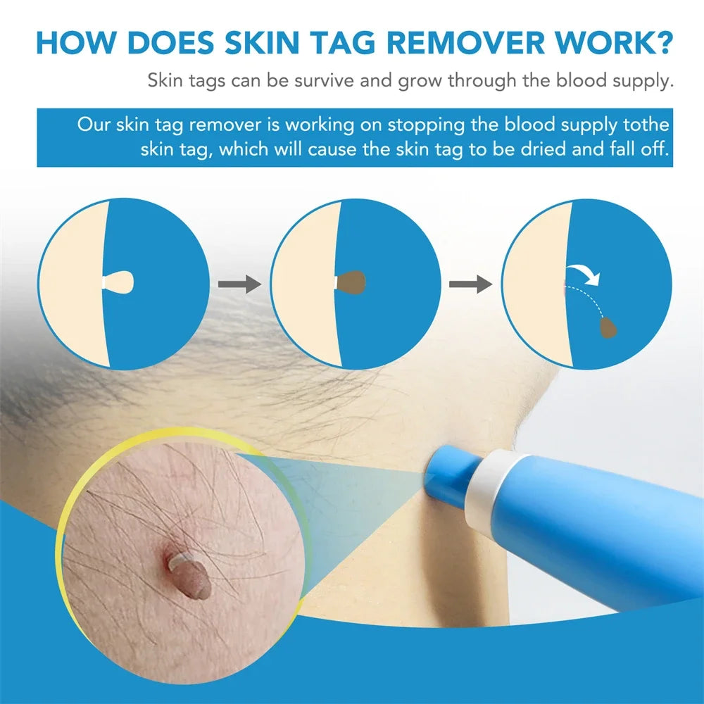 2-IN-1 Auto Micro Skin Tag Remover Kit