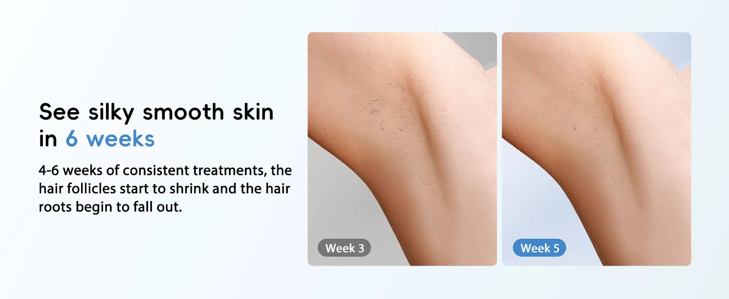 IPL Hair Removal Laser – Painless Epilator for Men & Women