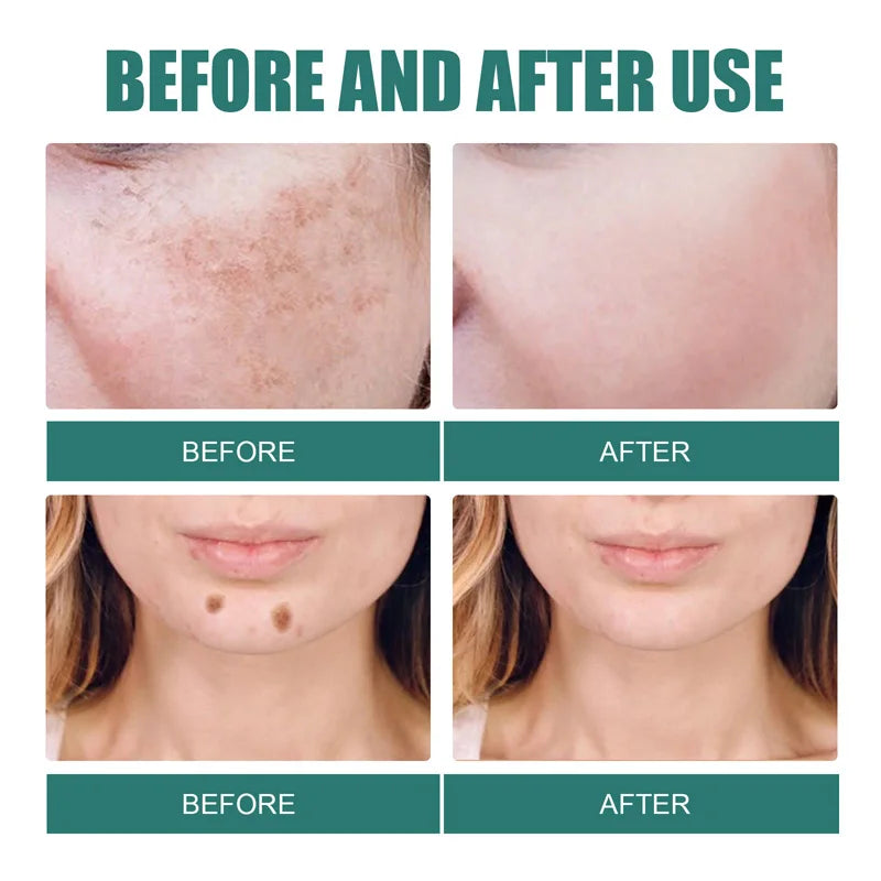 Niacinamide Whitening Freckle Cream Remove Dark Spot Melasma Pigmentation Brightening Cream Fade Stain Melanin Repair Skin Care