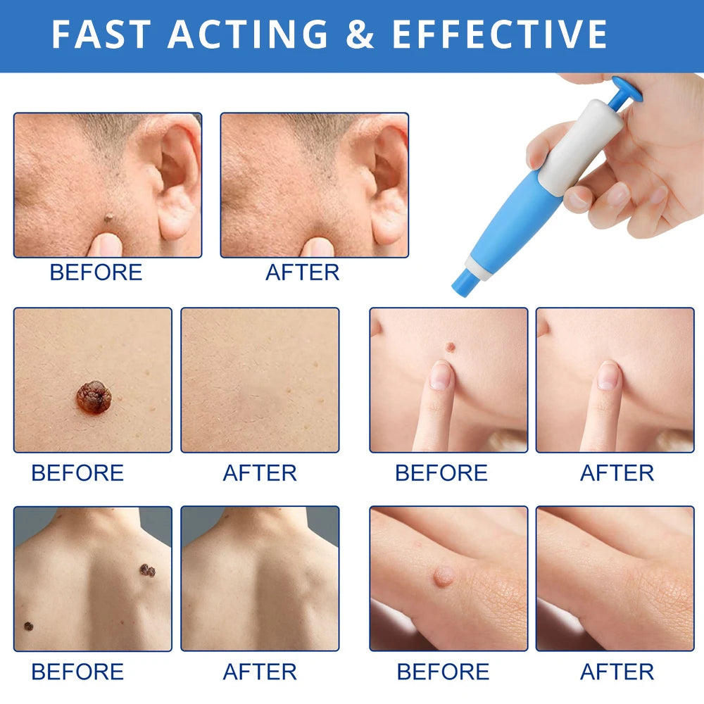 2-IN-1 Auto Micro Skin Tag Remover Kit