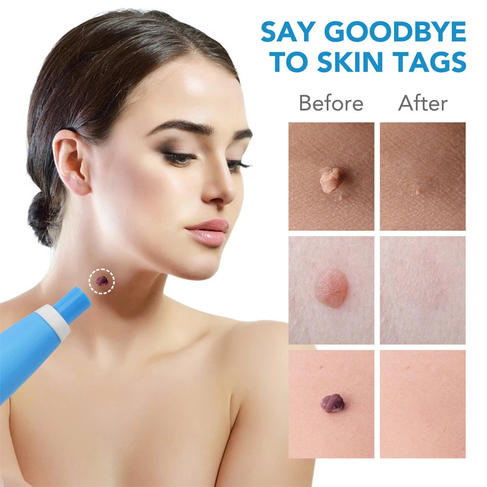 2-IN-1 Auto Micro Skin Tag Remover Kit