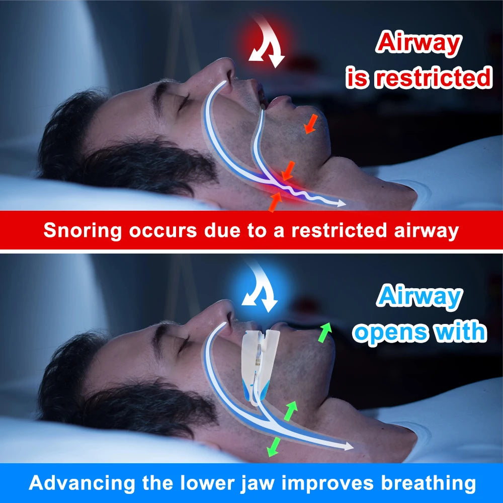 Teeth Bruxism Anti-Snoring Mouthpiece Device