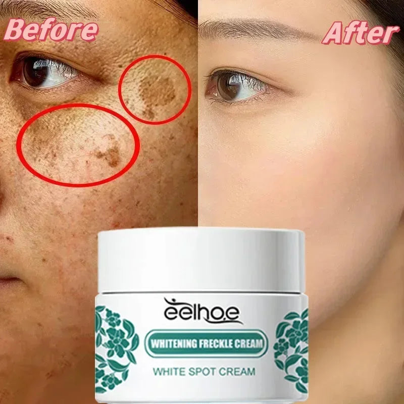 Niacinamide Whitening Freckle Cream Remove Dark Spot Melasma Pigmentation Brightening Cream Fade Stain Melanin Repair Skin Care