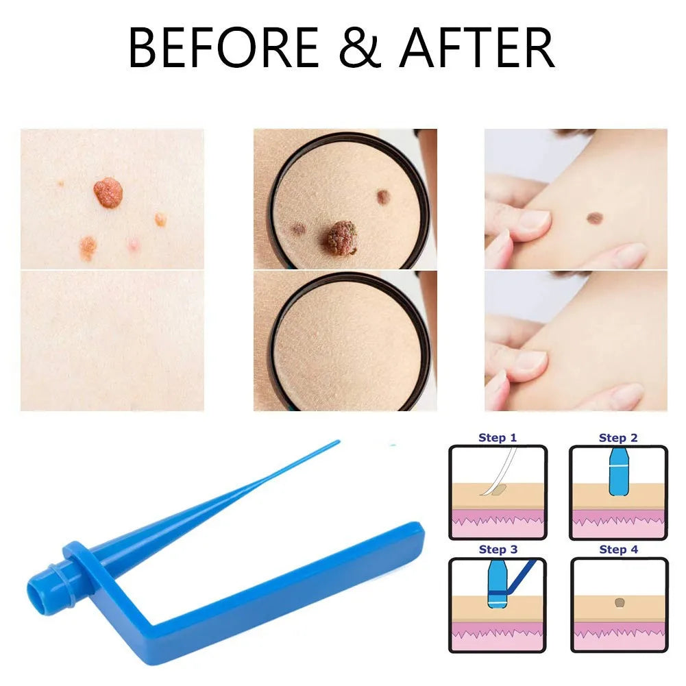 Skin Tag Removal Kit - Safe & Effective Micro Band Treatment Set