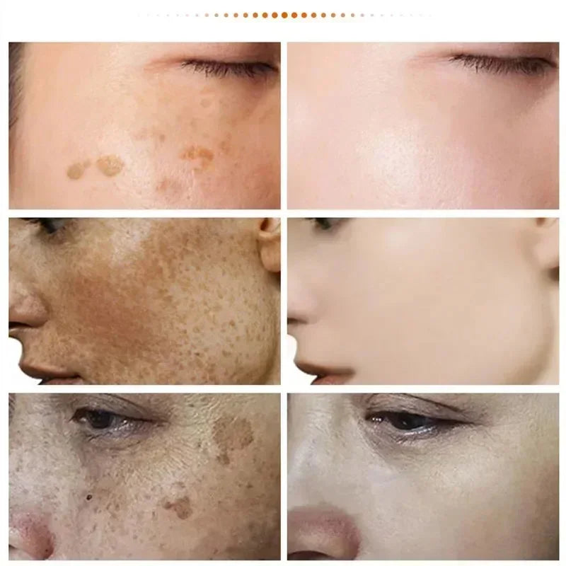 Niacinamide Whitening Freckle Cream Remove Dark Spot Melasma Pigmentation Brightening Cream Fade Stain Melanin Repair Skin Care