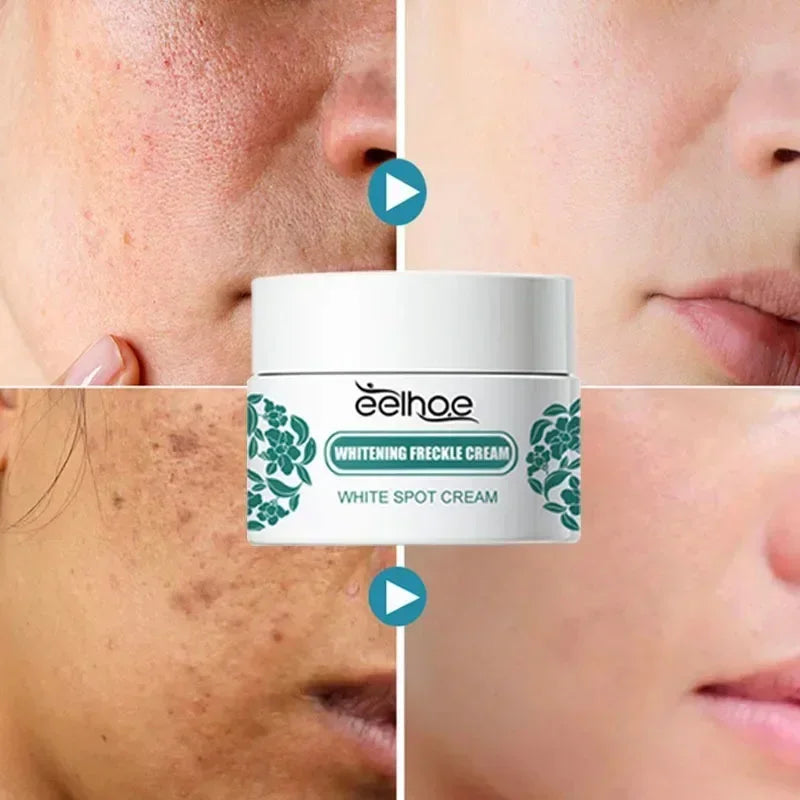 Niacinamide Whitening Freckle Cream Remove Dark Spot Melasma Pigmentation Brightening Cream Fade Stain Melanin Repair Skin Care